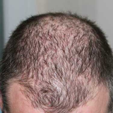 calvizie scalpo perdita capelli